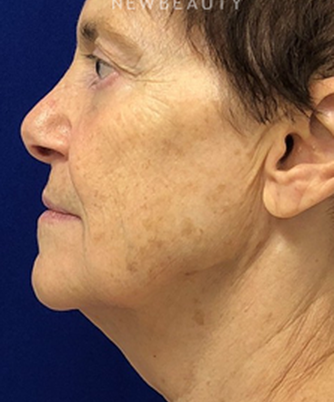 dr-dilip-madnani-facial-rejuvenation-b
