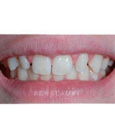 dr-guy-lewis-veneers-b