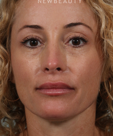 dr-kenneth-r-beer-juvederm-b