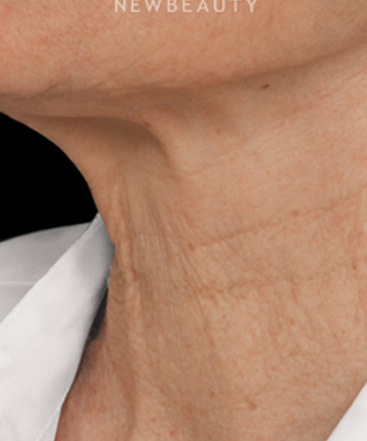 drs-jennifer-segal-scott-smith-microneedling-b