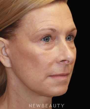 dr-dilip-madnani-facelift-b
