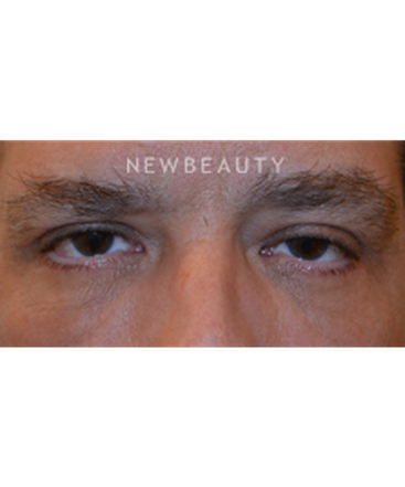 dr-baljeet-k-purewal-blepharoplasties-b