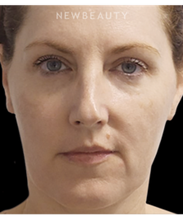 dr-marina-peredo-nonsurgical-lifting-and-tightening-b