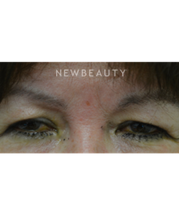 dr-baljeet-k-purewal-upper-blepharoplasty-b