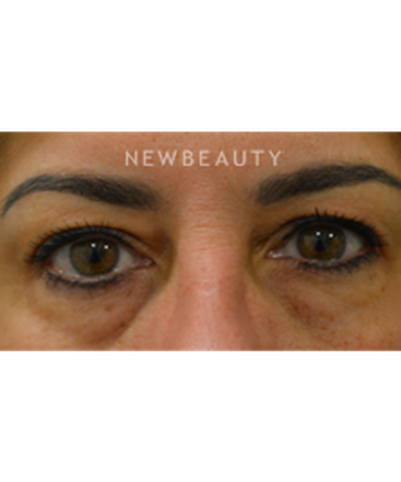 dr-baljeet-purewal-blepharoplasties-b