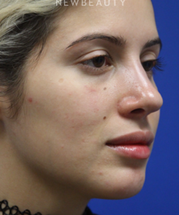 dr-jennifer-levine-rhinoplasty-b