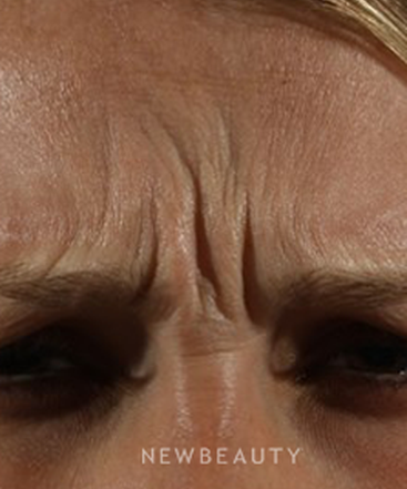dr-marina-peredo-botox-b