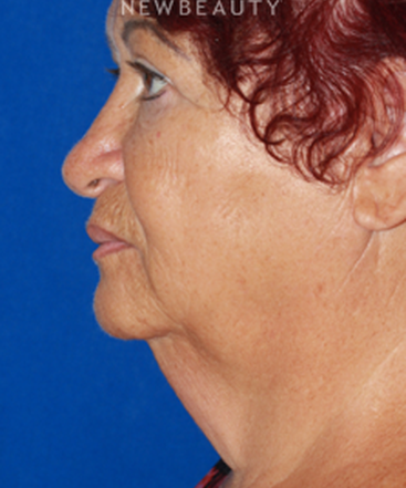 dr-konstantin-vasyukevich-lower-facelift-b