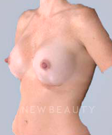 dr-bradley-bengtson-simulated-implants-b