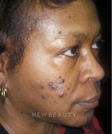 dr-charles-crutchfield-acne-treatments-b