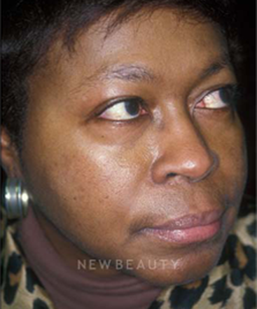dr-charles-crutchfield-acne-treatments-b