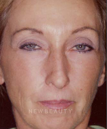 dr-charles-crutchfield-injectable-fillers-b