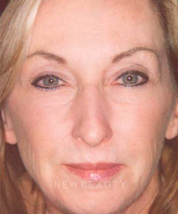 dr-charles-crutchfield-injectable-fillers-b