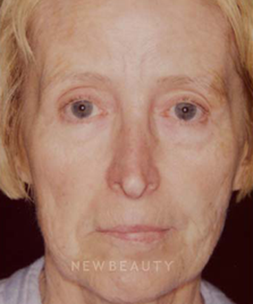 dr-charles-crutchfield-injectable-fillers-b