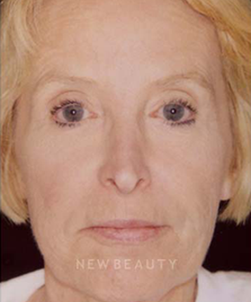 dr-charles-crutchfield-injectable-fillers-b