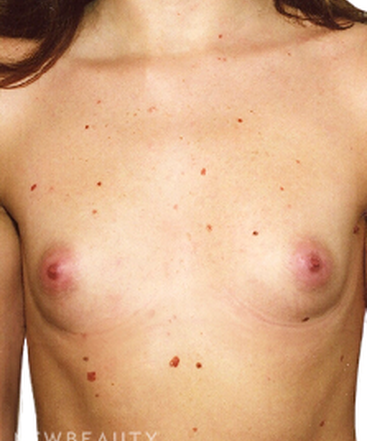 dr-david-rapaport-silicone-breast-implants-b