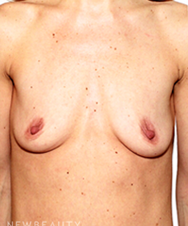 dr-david-rapaport-silicone-breast-implants-b