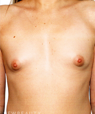 dr-david-rapaport-breast-implants-b