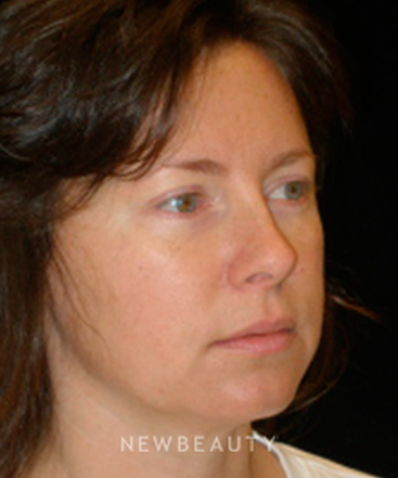 dr-phillip-chang-facelift-eyelift-lip-augmentation-b