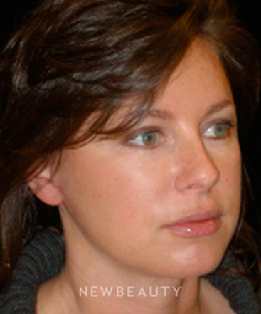 dr-phillip-chang-facelift-eyelift-lip-augmentation-b