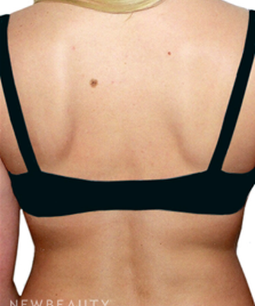 dr-david-rapaport-liposuction-b