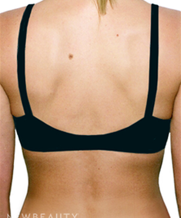 dr-david-rapaport-liposuction-b
