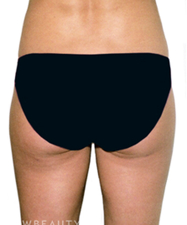 dr-david-rapaport-liposuction-b