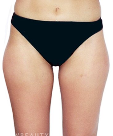 dr-david-rapaport-liposuction-b