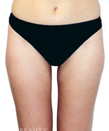 dr-david-rapaport-liposuction-b