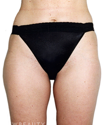 dr-david-rapaport-liposuction-b