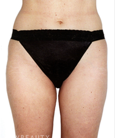 dr-david-rapaport-liposuction-b
