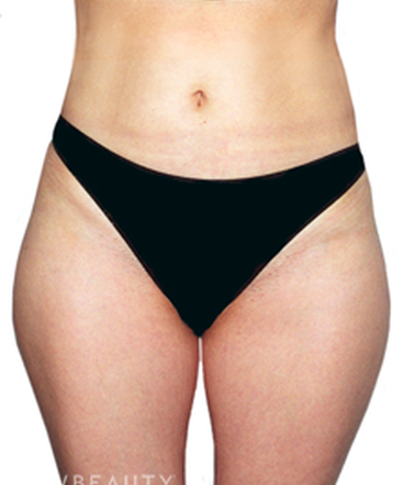 dr-david-rapaport-liposuction-b