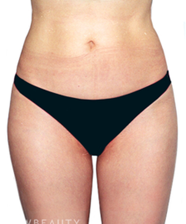 dr-david-rapaport-liposuction-b