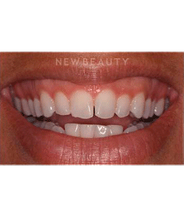 dr-laurence-rifkin-veneers-b