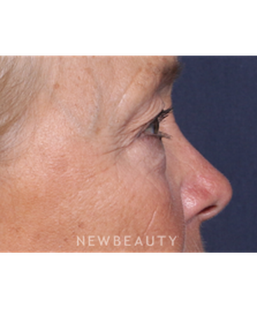 ljcsc-dr-smoot-eyelift-b