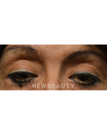 dr-baljeet-purewal-browlift-b