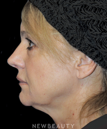 dr-brent-smith-upper-blepharoplasty-necklift-b