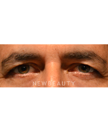 dr-baljeet-purewal-upper-blepharoplasty-b