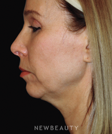 dr-brent-smith-facelift-rhinoplasty-lasers-chin-augmentation-b