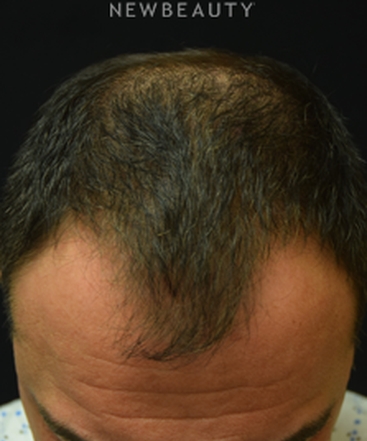 dr-jeffrey-b-wise-thinning-hair-resotration-b