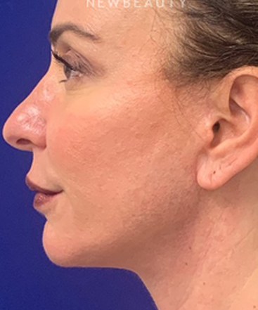 dr-dilip-madnani-facial-rejuvenation-b
