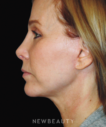 dr-brent-smith-facelift-rhinoplasty-lasers-chin-augmentation-b