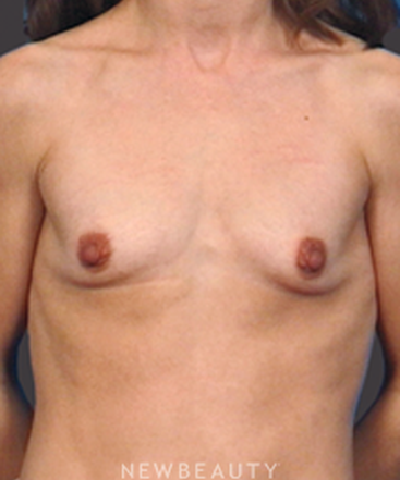 dr-bradley-bengtson-breast-augmentation-b