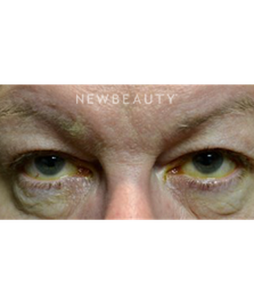 dr-baljeet-k-purewal-blepharoplasty-b