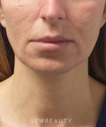 dr-marina-peredo-juvederm-vollure-b