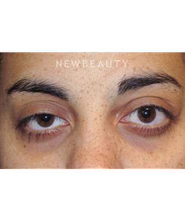 dr-raymond-douglas-under-eye-filler-b