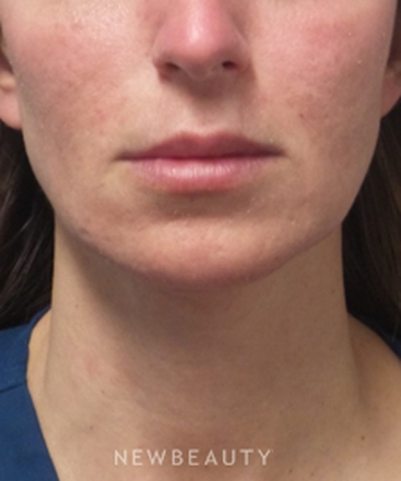 dr-marina-peredo-juvederm-vollure-b
