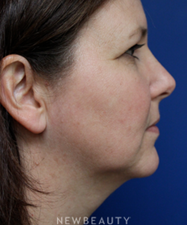 dr-joseph-russo-a-balanced-facial-profile-b