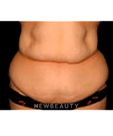 dr-sanjay-grover-tummy-tuck-b