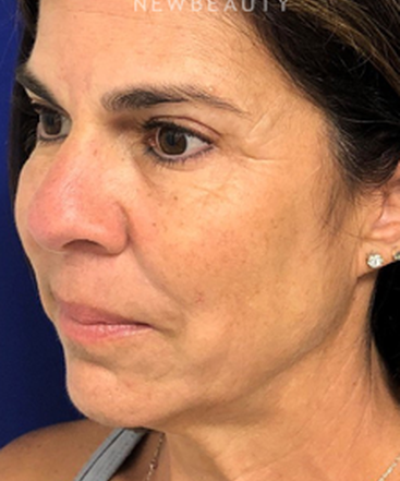 dr-dilip-madnani-facelift-necklift-b